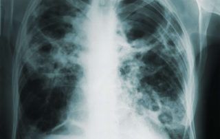 Infecciones pulmonares | MITLAB